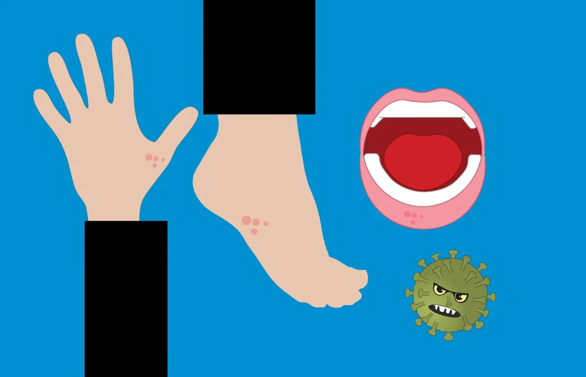 Campak Merebak di Cirebon, Empat Kecamatan Berstatus KLB